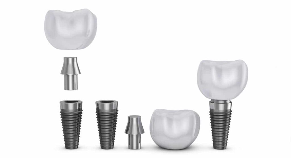Tipos de implantes dentales con corona