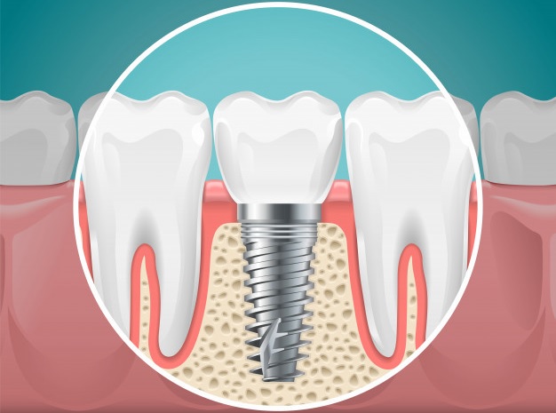 esquema que muestra un implante dental en la boca