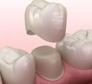coronas_dentales
