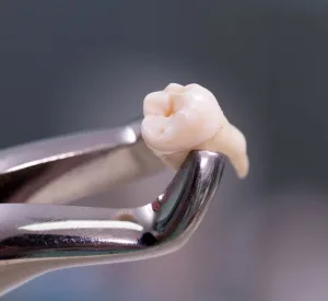 exodoncia-clinica-dental-julian-saiz-01