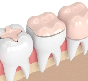 incrustaciones-dentales02-1058x675