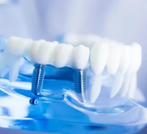 Tratamiento de implantología